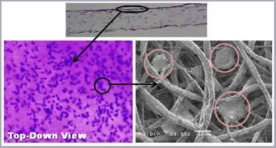 Figure 1: (Top) Histological cross-section of PCL seeded with JBC. Cells are stained purple. (Bottom Left) Top-down light microscope view of cells immediately following seeding. Scaffold stains pink, cells purple. (Bottom Right) Scanning Electron Microscope (SEM) image of cells (circled) attached to electrospun ECM analogue.
